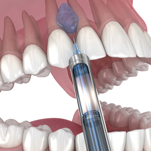 Close up of anesthetic injection